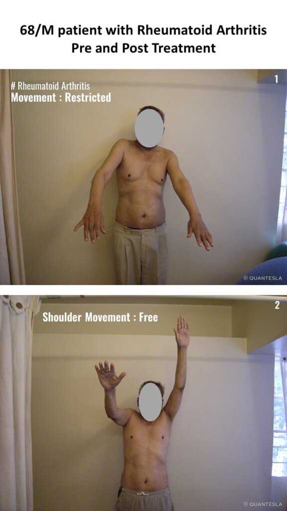 RA-Shoulder pre and post treatment photos