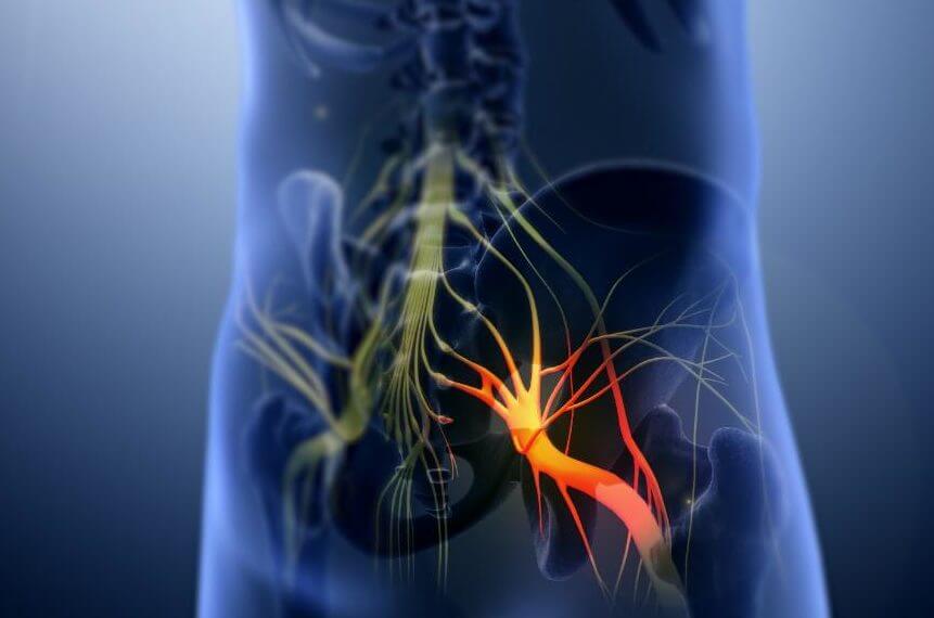 Sciatica and Physiotherapy