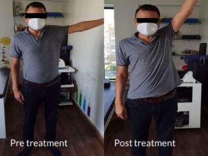 shoulder pain Before and after treatment photos of a man with restricted shoulder mobility, showing improved arm elevation post-therapy